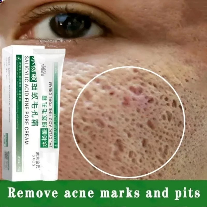 Azelaic Acid Cream - Crema limpiadora de poros de ácido