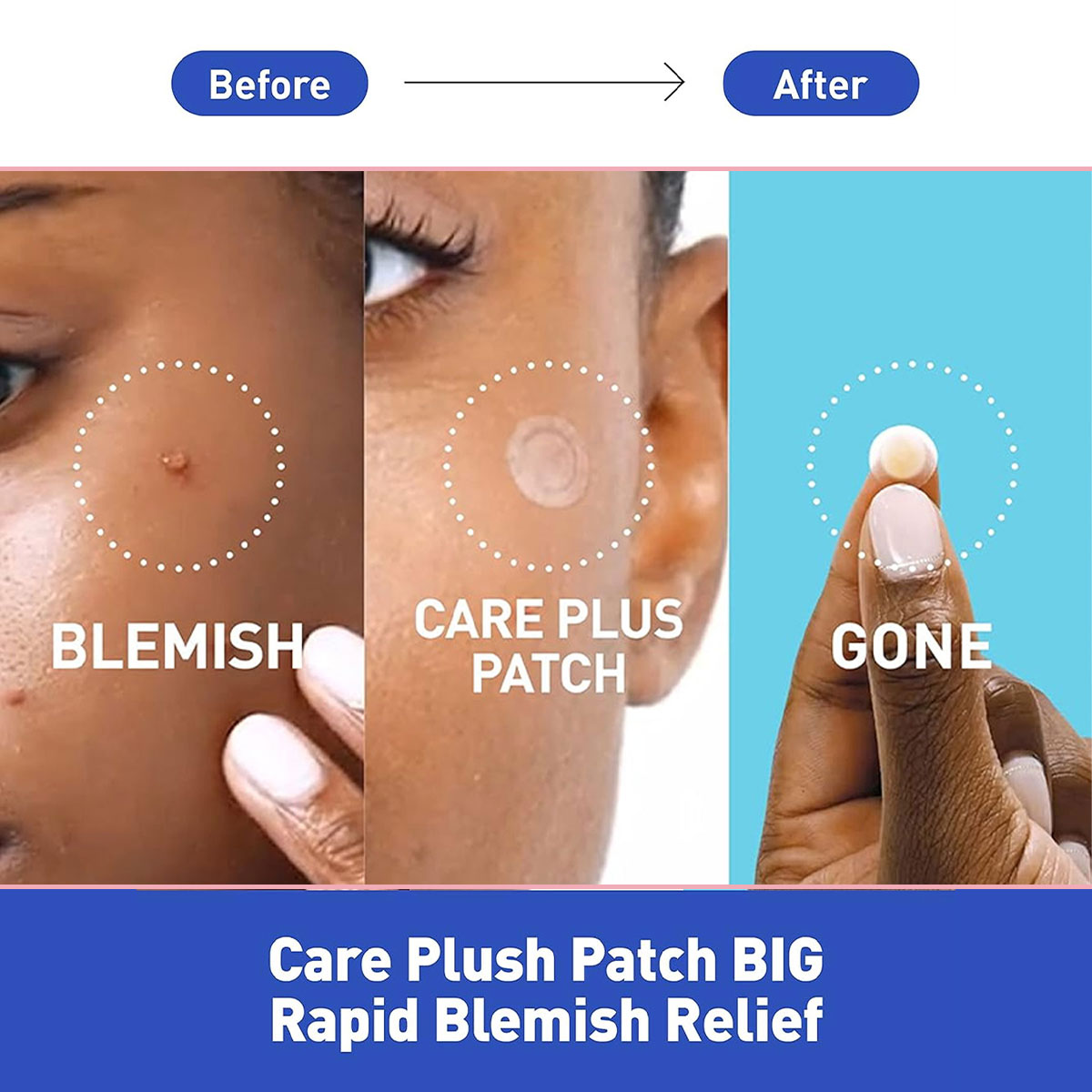 Parches para Cubrir Manchas Ol - Skincare Moisturizer reseña y precio