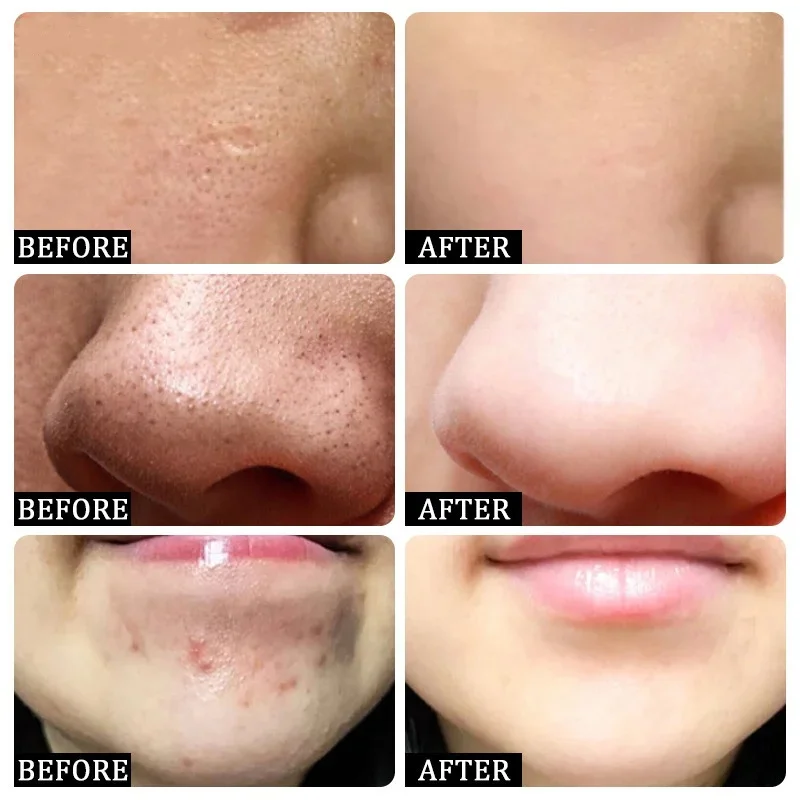 Crema limpiadora de poros de á - Azelaic Acid Cream reseña y precio