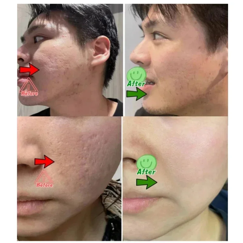 Crema limpiadora de poros de á - Azelaic Acid Cream reseña y precio