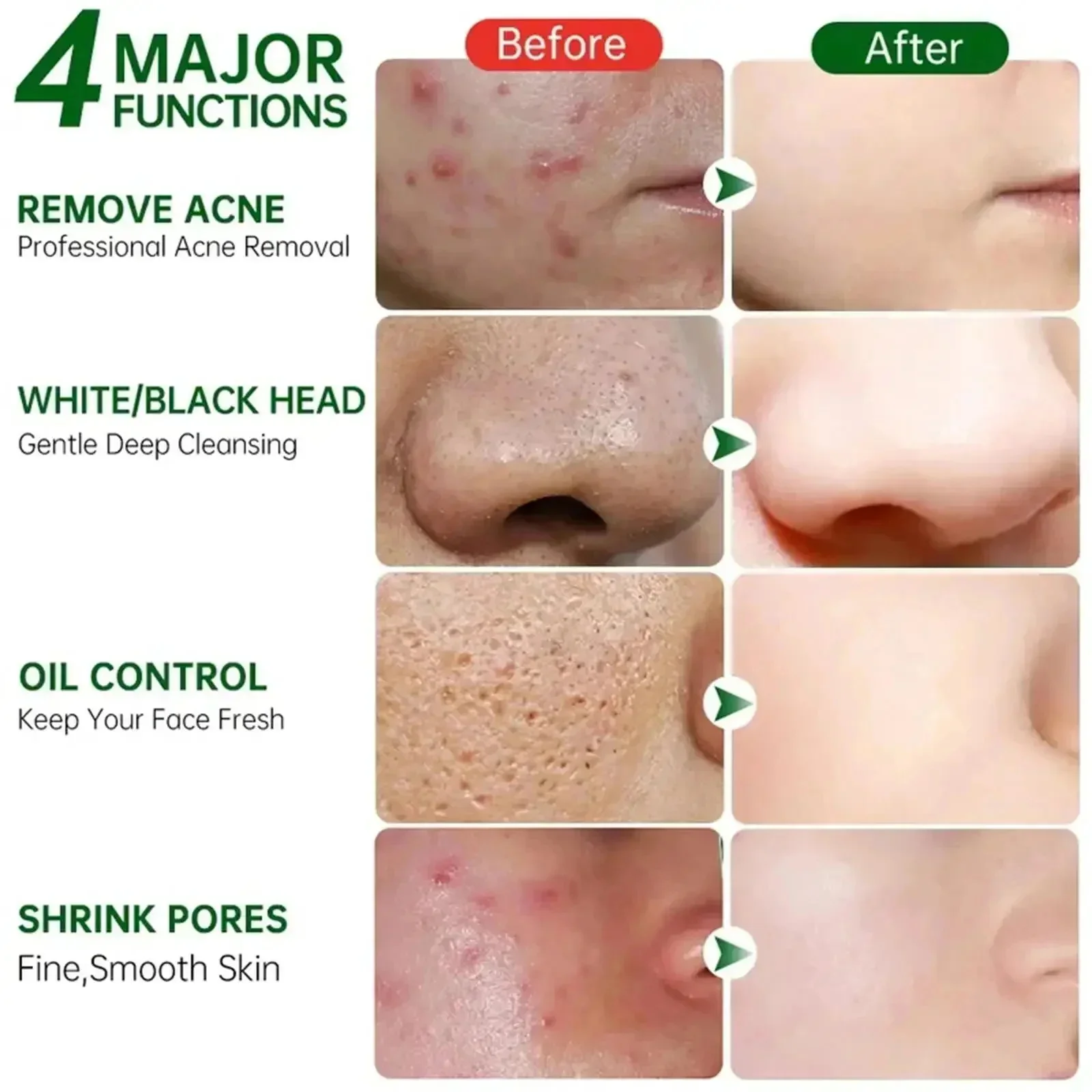 Crema limpiadora de poros de á - Azelaic Acid Cream reseña y precio